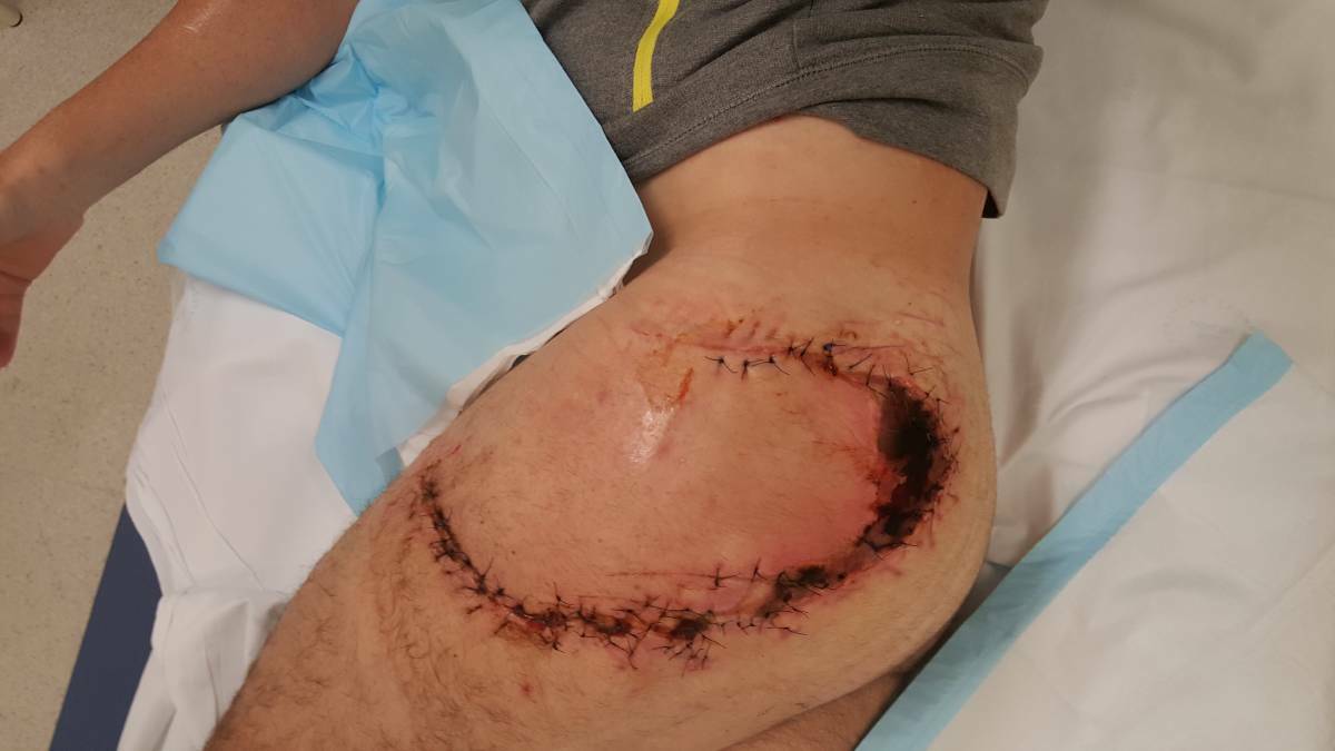 Dale Carr's horrific injury sustained after a shark attack attack at Lighthouse Beach.