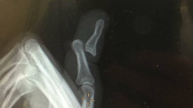 The X-ray from Jono Dean's dislocated finger. Photo: Supplied
